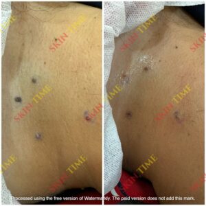 Mole Removal Treatment